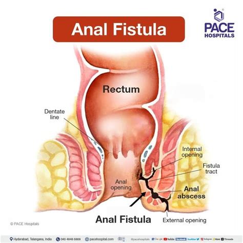 Anal Fistula Symptoms Causes Types Complications Off