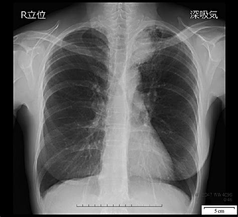 Chest X Ray Chest X Ray Showing A Tumor Shadow In The Left Upper Lung