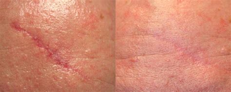 Scar Treatment By A Greater Houston Tx Dermatologist Dermsurgery