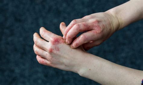 Common Causes Of Contact Dermatitis And Their Treatments • Iinuma Seiji