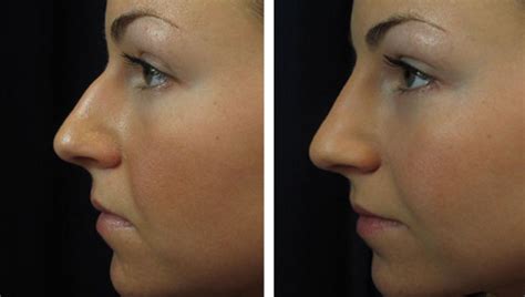 Non surgical nose job for wide nose uk. Non Surgical Nose Job | Boston's Best | Visage Sculpture
