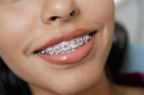 Braces & Oral Care - All About Smiles