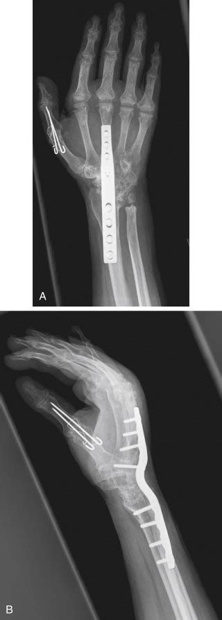 Wrist Rheumatoid Arthritis Musculoskeletal Key