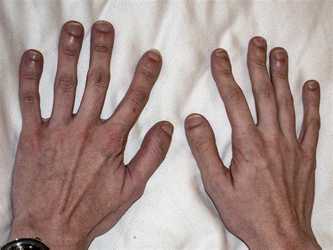 Clubbed Fingers Causes Symptoms Treatment And When To Seek Help