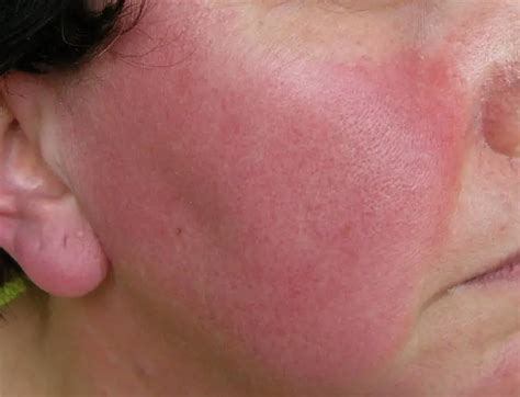 Red In The Face We Look At Rosacea And Treatments That Work Blue Hare Magazine