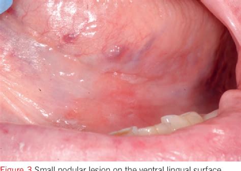 Figure 1 From The Early Diagnosis Of Small Sized Oral Squamous Cell