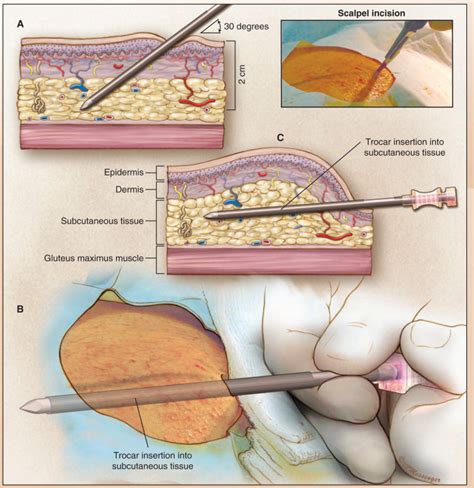 Surgical Techniques Subcutaneous Testosterone Pellet Implantation Procedure For Treatment Of