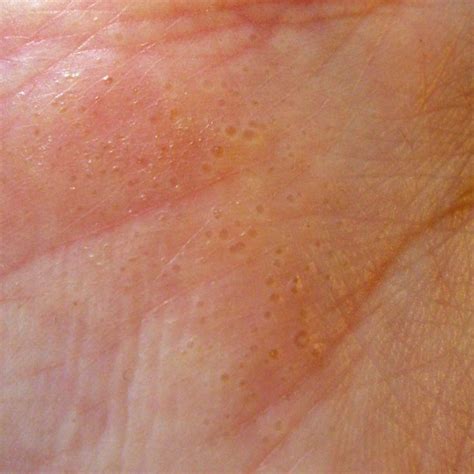 Sintético 94 Foto Dermatitis En Dedos De La Mano El último 102023
