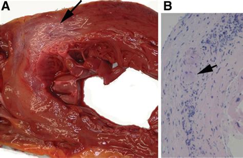 Heart muscle inflammation (myocarditis) is an inflammatory process of the heart muscle, which can be acute or chronic in nature. Diagnosis, Treatment, and Outcome of Giant-Cell ...