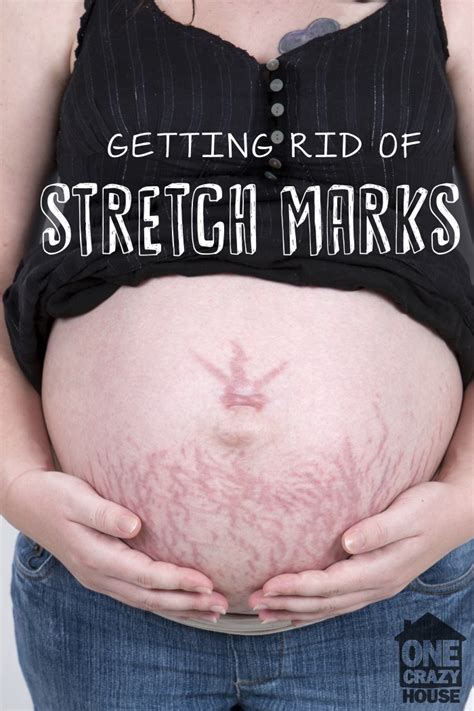 Ten Tips On How To Make Those Stretch Marks Disappear