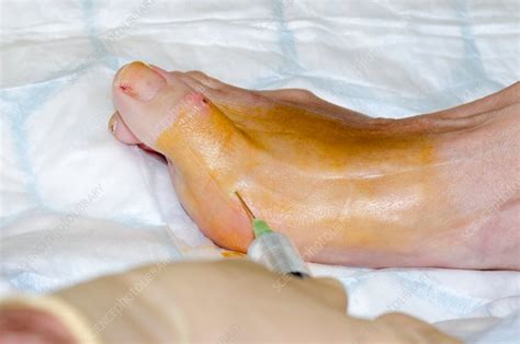 Foot Surgery Stock Image C0141040 Science Photo Library