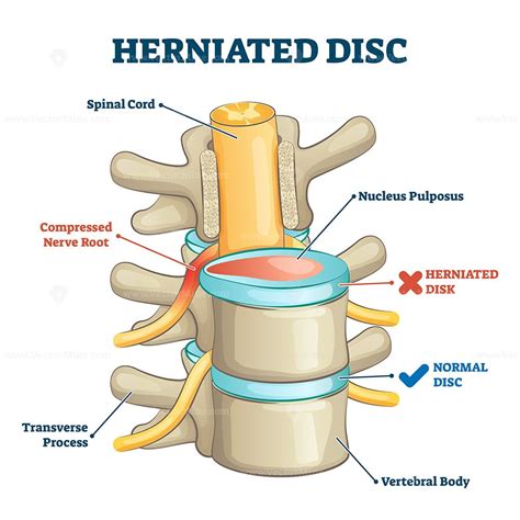 Herniated Disc Injury D Side View On Spine Bone Skeleton Vector