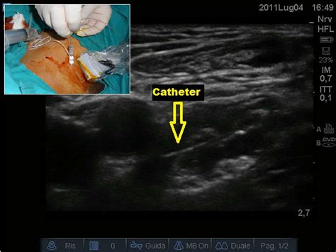 Ultrasound Guided Femoral Nerve Block Catheter Insertion Download