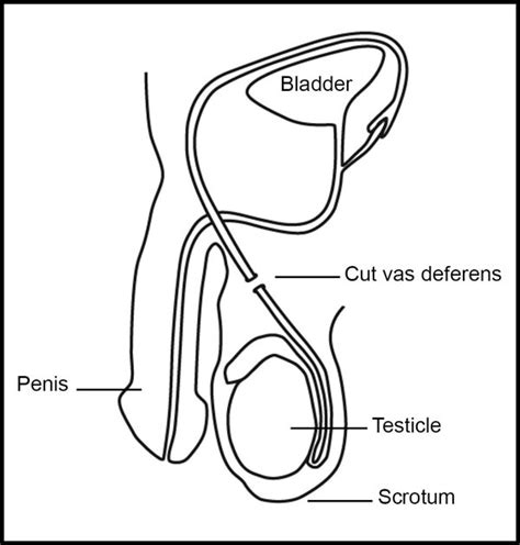 vasectomy labeled boxed shine sa