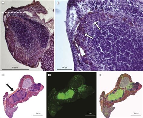 Detection Of Oral Squamous Cell Carcinoma And Cervical Lymph Node