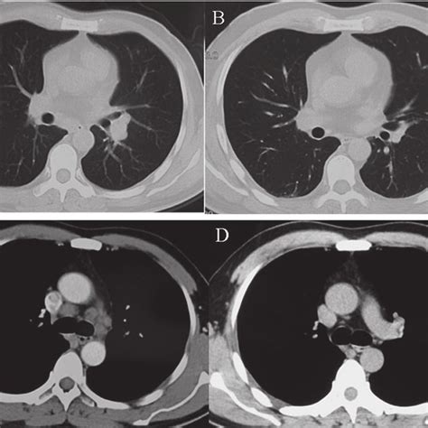 Ct Of The Chest Showed Mediastinal And Hilar Lymphadenopathy And