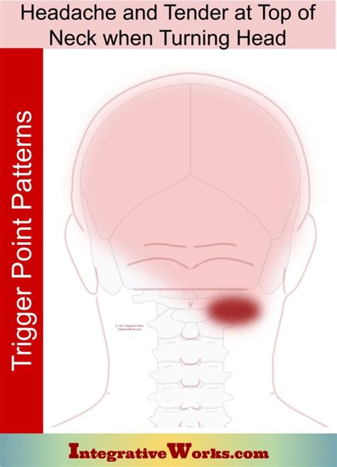 Trigger Point Patterns Headaches Cervicogenic Integrative Works