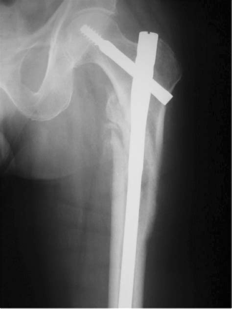 Intertrochanteric Fracture Treated With Long Cephalomedullary Nail