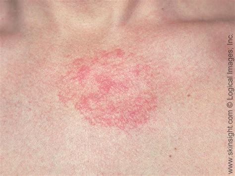 What Is Seborrheic Dermatitis