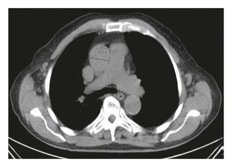 A Ct Scan Showing Mediastinal Lymphadenopathy Measuring 353 Mm