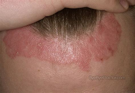 Scalp Psoriasis Symptoms Symptoms Causes Treatment And Prevention Of