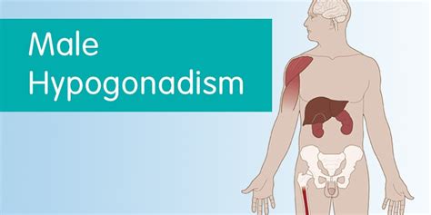 Male Hypogonadism Pictures
