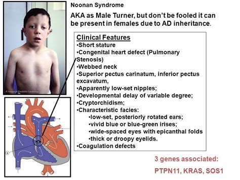 The child may have problems in the secretion of the thyroid hormone. Pin by nonas arc on Noonan Syndrome | Congenital heart ...