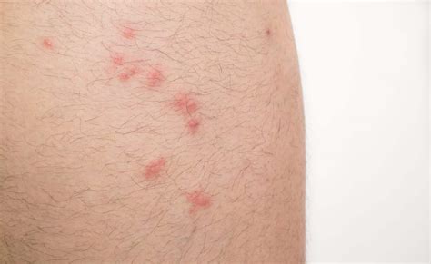Flea Bites On Humans Nextgen Pest Solutions