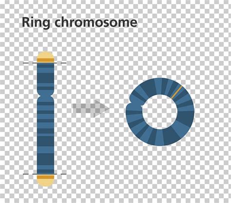 Ring Chromosome 14 Syndrome Chromosome Abnormality Genetics Png