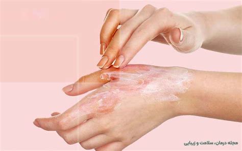 آشنایی با انواع درمان خانگی سوختگی پوست ویکی درمان ️