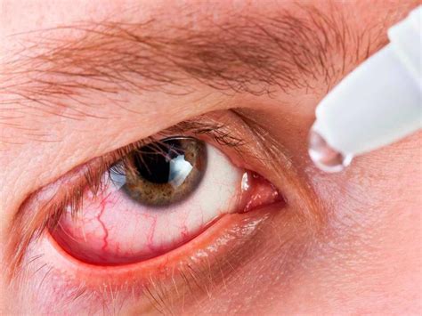 Dry Eyes Demystified Accent Vision Specialists Optometric Physicians