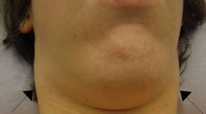 Lumps in the muscles of the neck are caused by injury or Lump under Chin - Causes: (Right or Left Side), Near ...