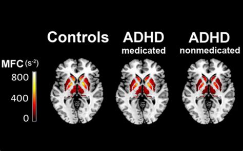 What Is Adhd Brain Learn Adhd Brain Vs Normal Brain