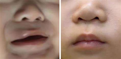 Deep Hemangioma Of The Upper Lip Before And After Therapy Download