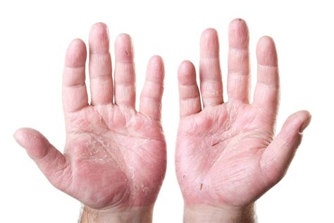 Simple Home Remedies To Treat Skin Peeling On Hands And Fingers