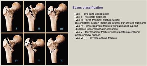 Diagram Of Femur Bone