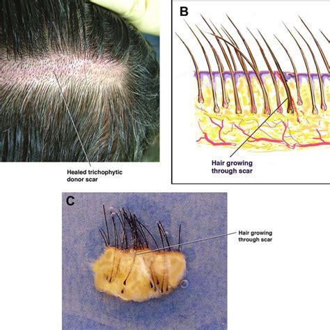 Surgical Anatomy Of The Scalp A Frontal View Emphasizing The Level