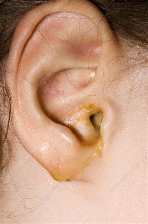 Ear Infection Stock Image M1570073 Science Photo Library