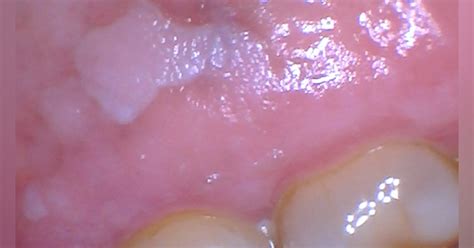 Do You Have A Patchy Understanding Of Leukoplakia Registered Dental