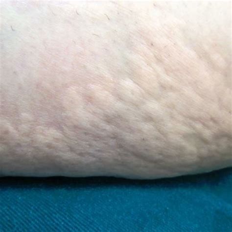 Large Indurated Plaques On The Forearm With A Pale And Peau Dorange