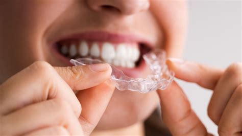Spark Clear Aligners Or Invisalign Pros And Cons Of Each
