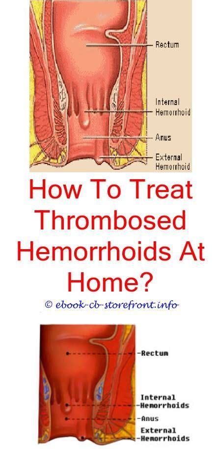 Learn about hemorrhoid surgery (hemorrhoidectomy), including why it's done, risks and complications, how to prepare, and what to expect. 4 Terrific Tips: What Is The Treatment For Internal Hemorrhoids hemorrhoid surgery how to get.Do ...