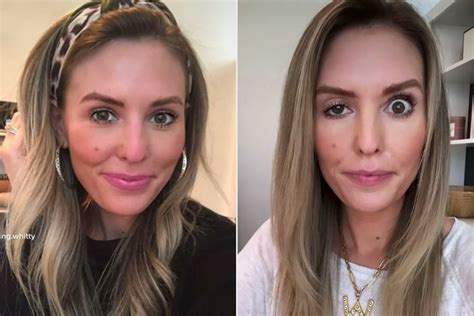 influencer whitney buha candidly reveals what happens when botox goes wrong people zton ten