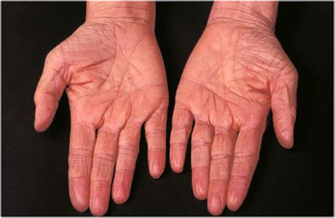 Ichthyosis Vulgaris An Updated Review Jaffar 2023 Skin Health