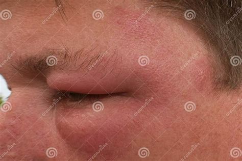Closeup Shot Of A Female Swollen Eye From A Bee Sting Stock Image