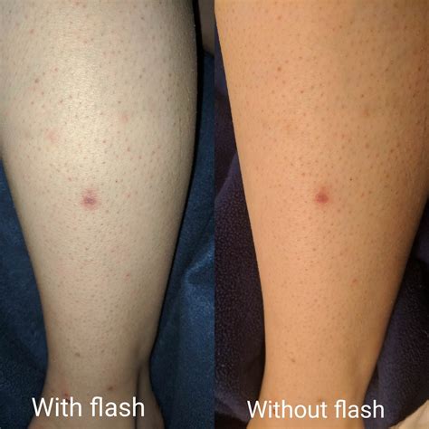 It usually happens after shaving, waxing, or tweezing on your legs. Ingrown Hair Scars Black Skin - beautiful Party Wear ...