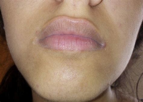 Skin Concerns Dark Skin Around Mouth Skincareaddiction