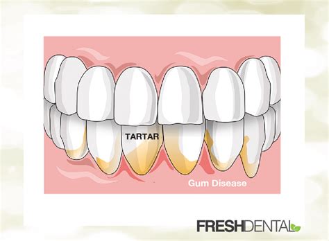 Gum Disease Treatment In Park Road Nc Fresh Dental