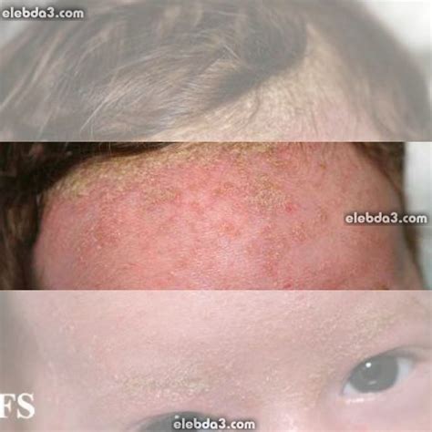 مدوّنة الامراض الجلدية عند الأطفال امراض الجلد 🖋️ مجلة الرياضة و الصحة