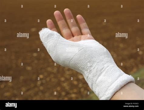 Plaster After Wrist Fracture Hi Res Stock Photography And Images Alamy